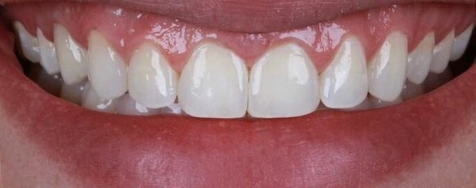Depois: fechamento de diastema