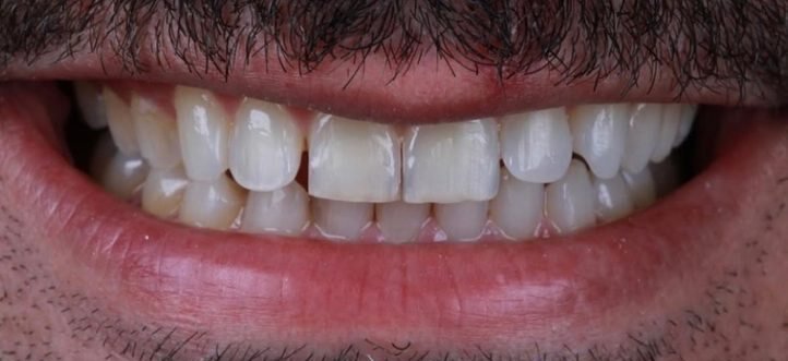 Antes: facetas em resina