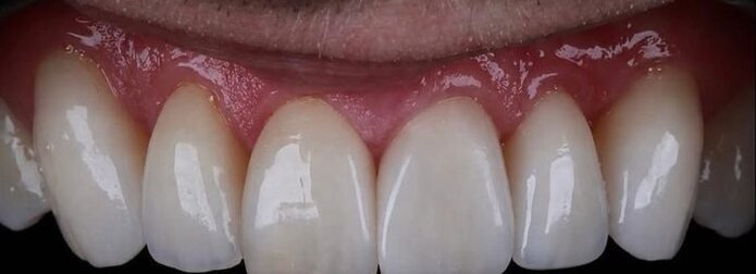 Antes: lentes de porcelana