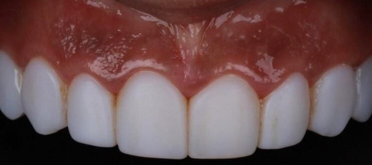 Antes: substituição de lentes antigas