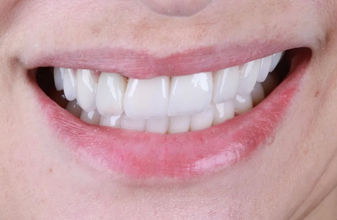 Sorriso com lentes de porcelana